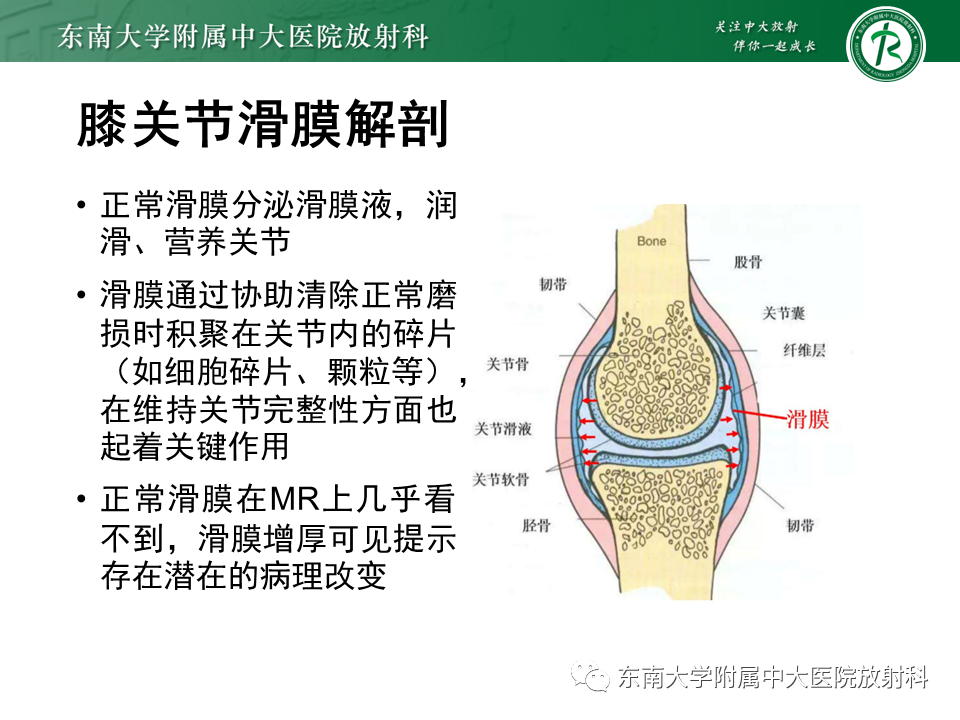 影像PPT - 【PPT】膝关节腱鞘巨细胞瘤-7