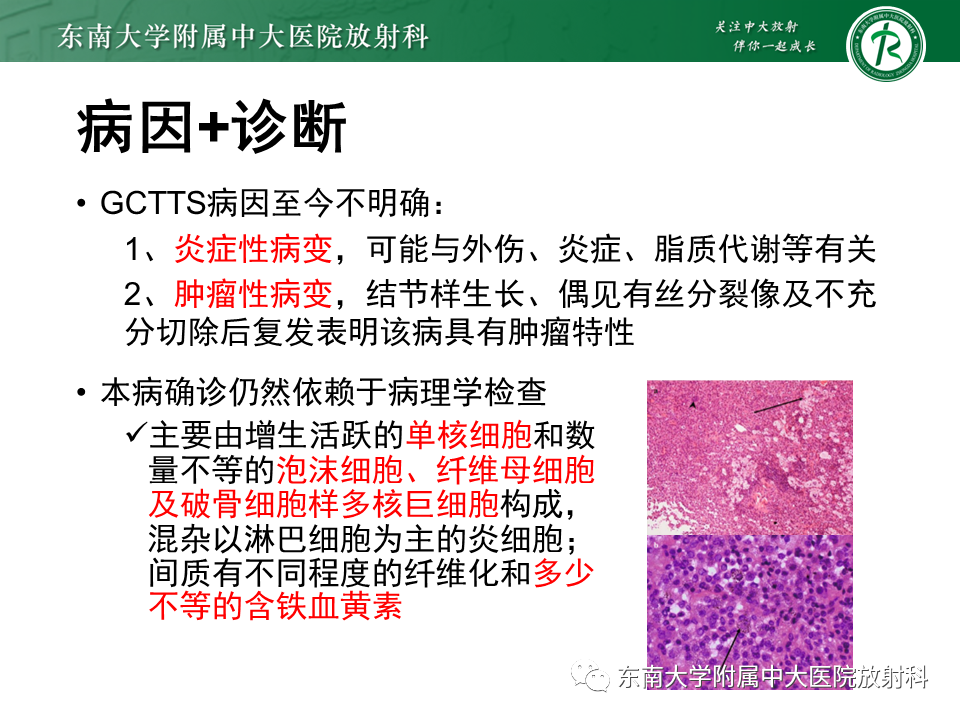 影像PPT - 【PPT】膝关节腱鞘巨细胞瘤-8