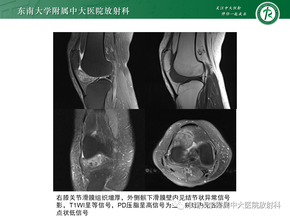 影像PPT - 【PPT】膝关节腱鞘巨细胞瘤-13