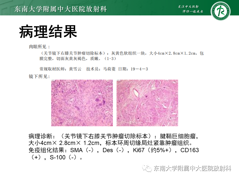 影像PPT - 【PPT】膝关节腱鞘巨细胞瘤-14