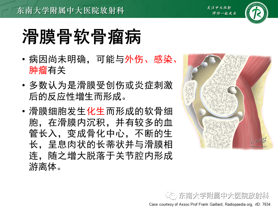 影像PPT - 【PPT】膝关节腱鞘巨细胞瘤-18