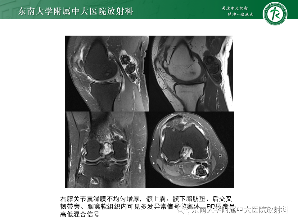影像PPT - 【PPT】膝关节腱鞘巨细胞瘤-21
