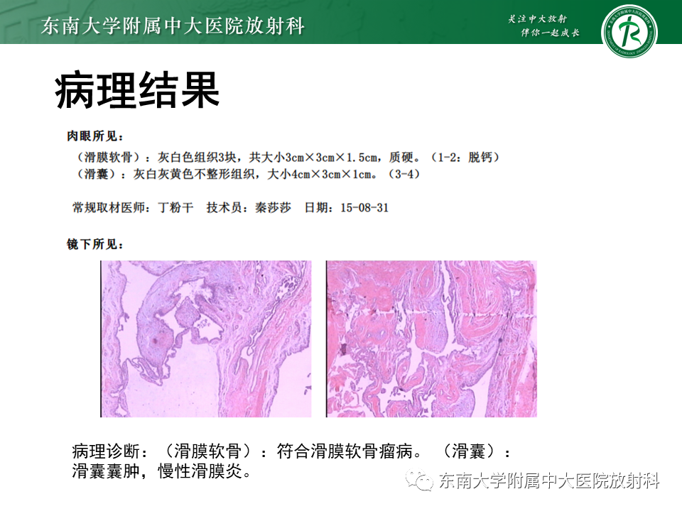 影像PPT - 【PPT】膝关节腱鞘巨细胞瘤-22