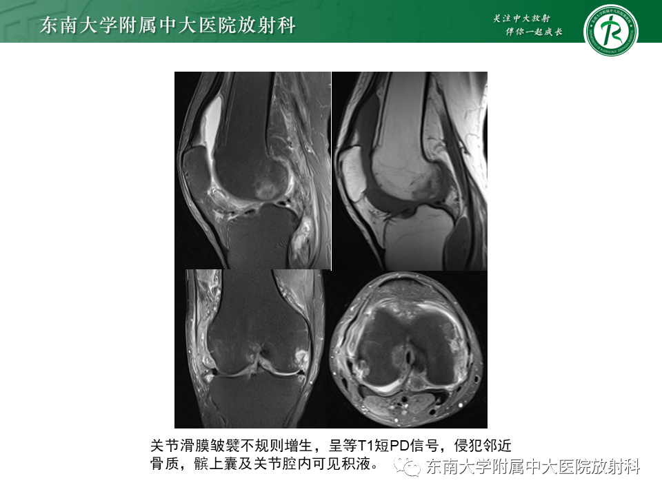 影像PPT - 【PPT】膝关节腱鞘巨细胞瘤-26