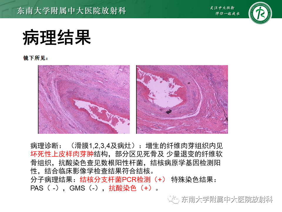 影像PPT - 【PPT】膝关节腱鞘巨细胞瘤-27