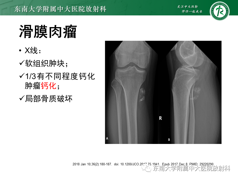 影像PPT - 【PPT】膝关节腱鞘巨细胞瘤-29