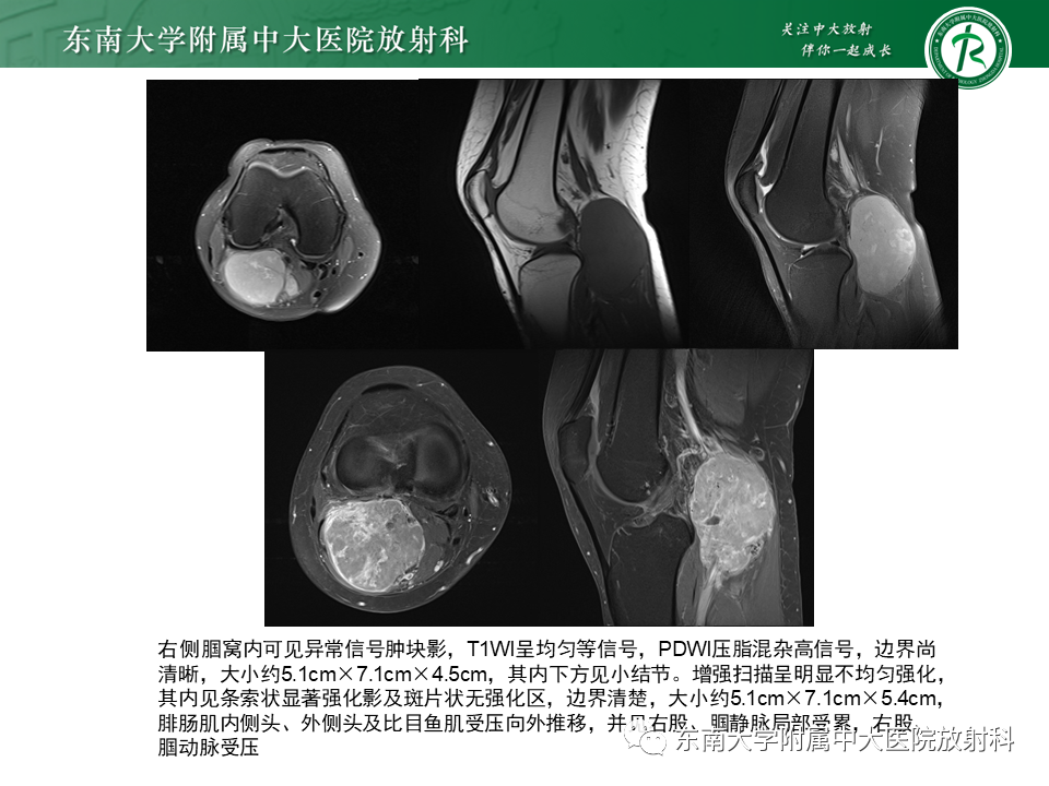 影像PPT - 【PPT】膝关节腱鞘巨细胞瘤-33
