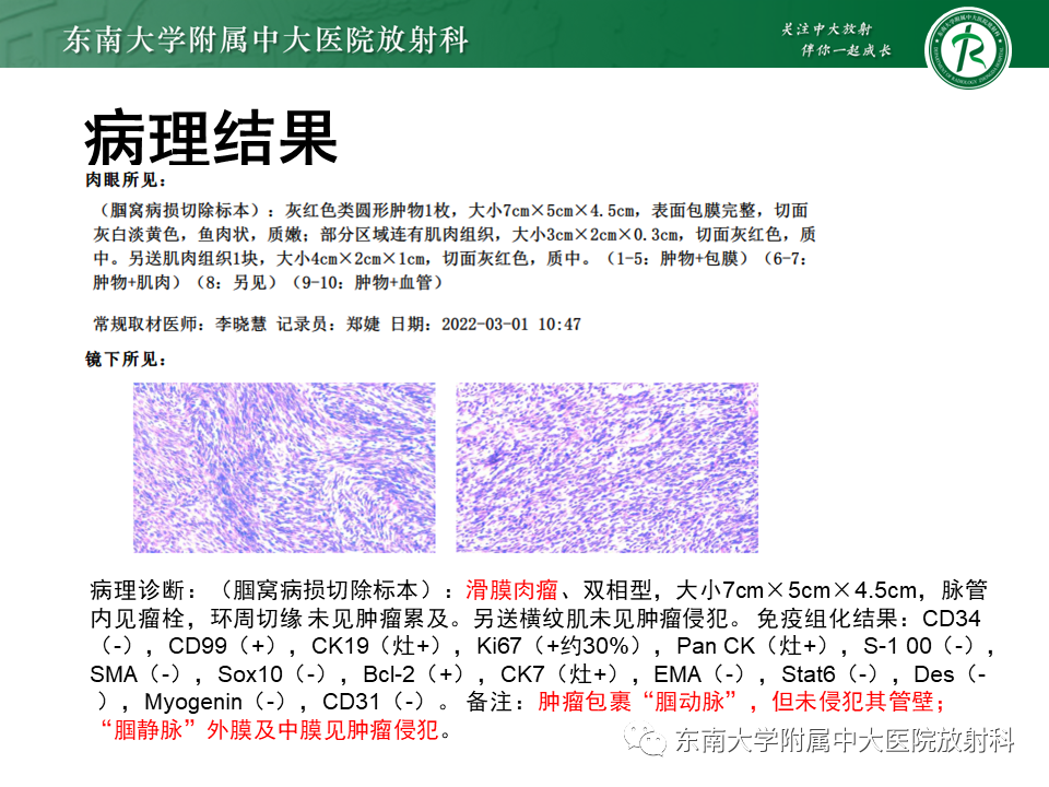 影像PPT - 【PPT】膝关节腱鞘巨细胞瘤-34