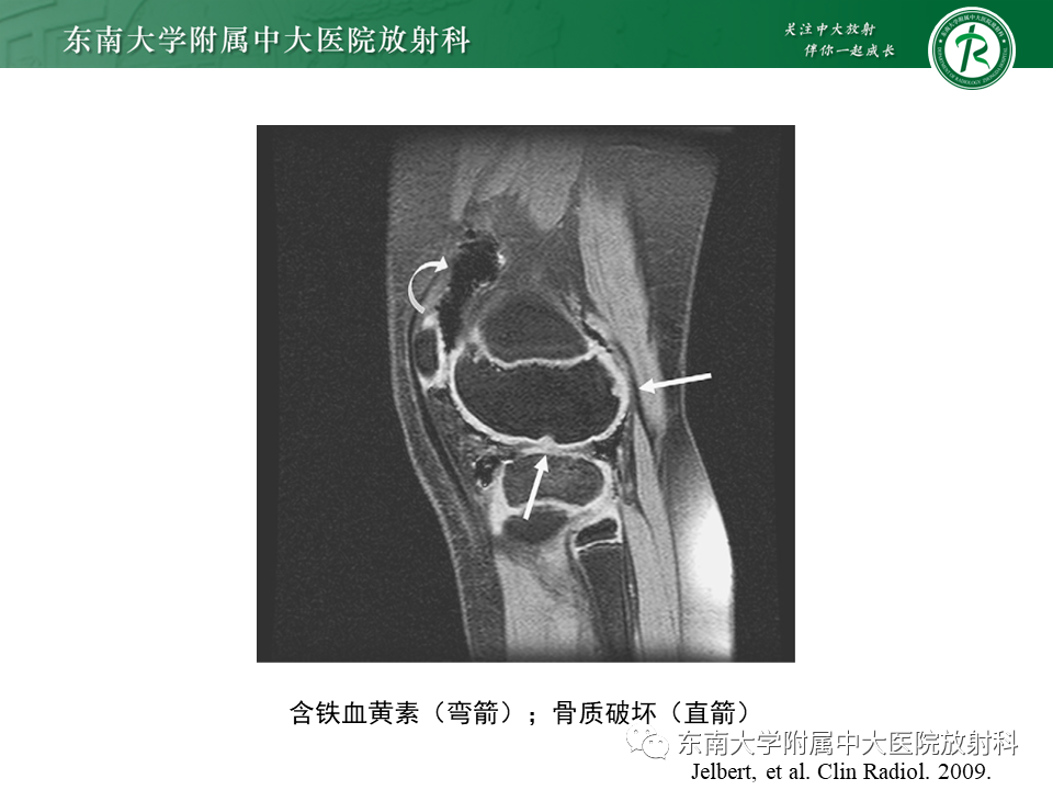 影像PPT - 【PPT】膝关节腱鞘巨细胞瘤-36