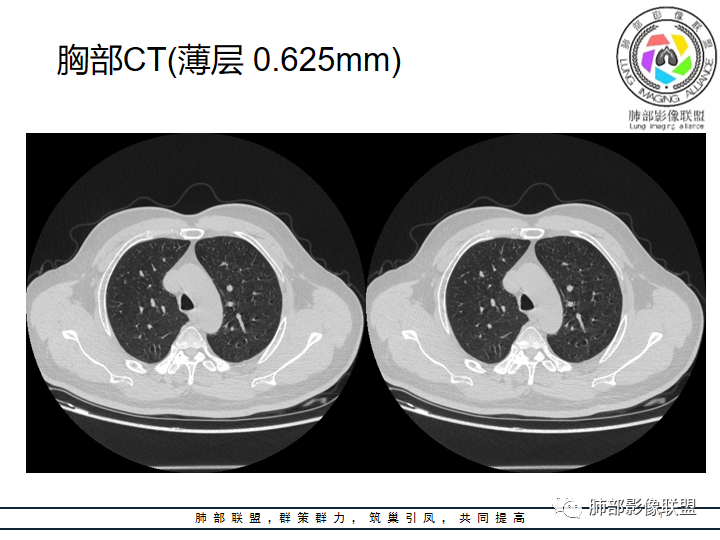 影像PPT - 【病例】诡异的肺结节!-10 影像PPT - 【病例】诡异的肺结节!-10