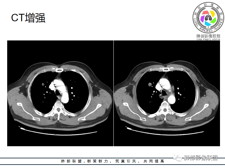 影像PPT - 【病例】诡异的肺结节!-19 影像PPT - 【病例】诡异的肺结节!-19