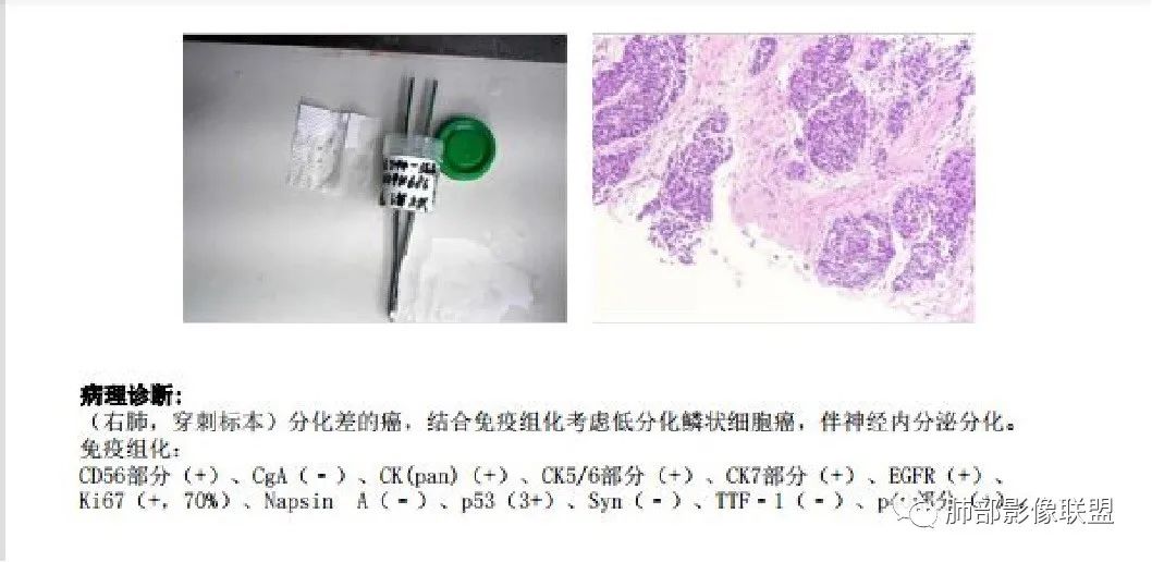 影像PPT - 【病例】诡异的肺结节!-26 影像PPT - 【病例】诡异的肺结节!-26