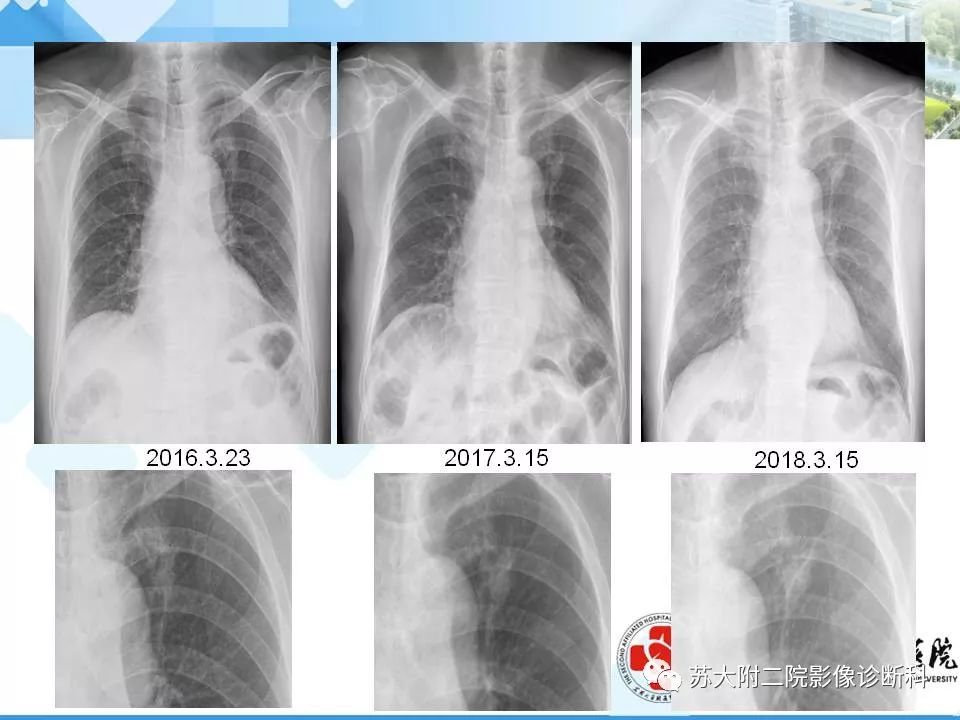 影像PPT - 【PPT】胸部X线平片的漏诊陷阱-3