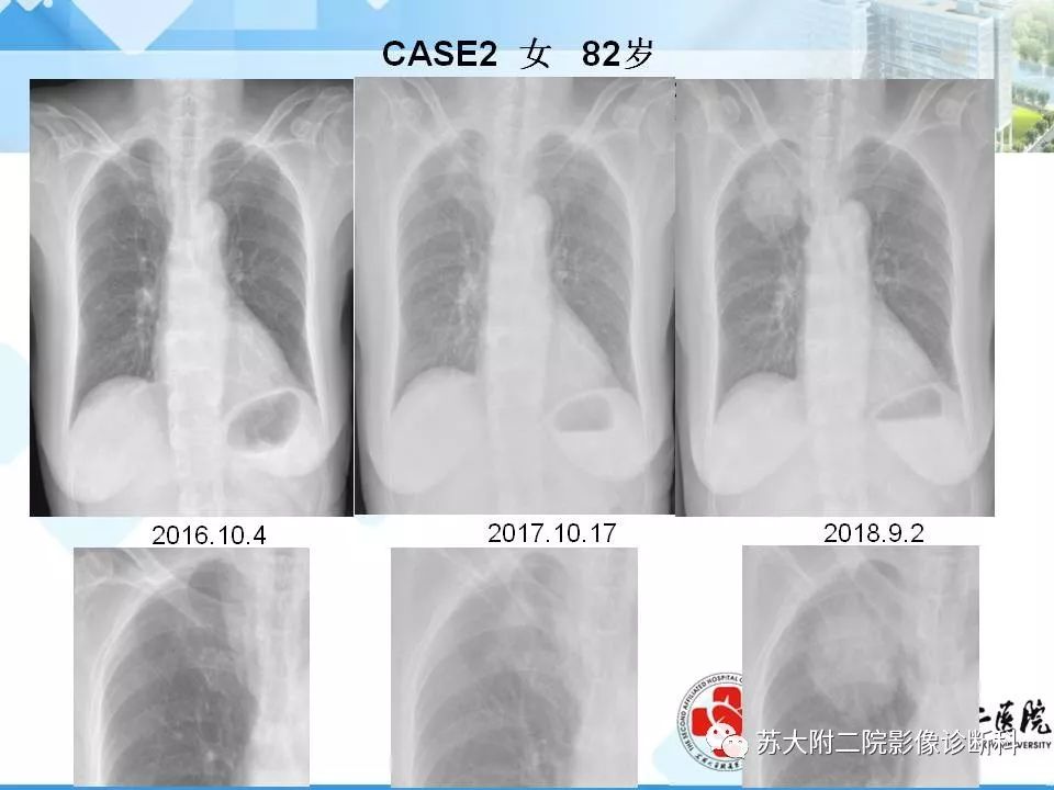 影像PPT - 【PPT】胸部X线平片的漏诊陷阱-5