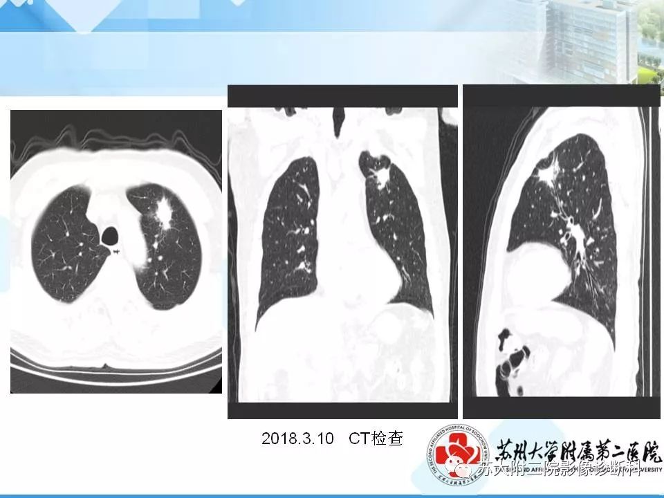 影像PPT - 【PPT】胸部X线平片的漏诊陷阱-4