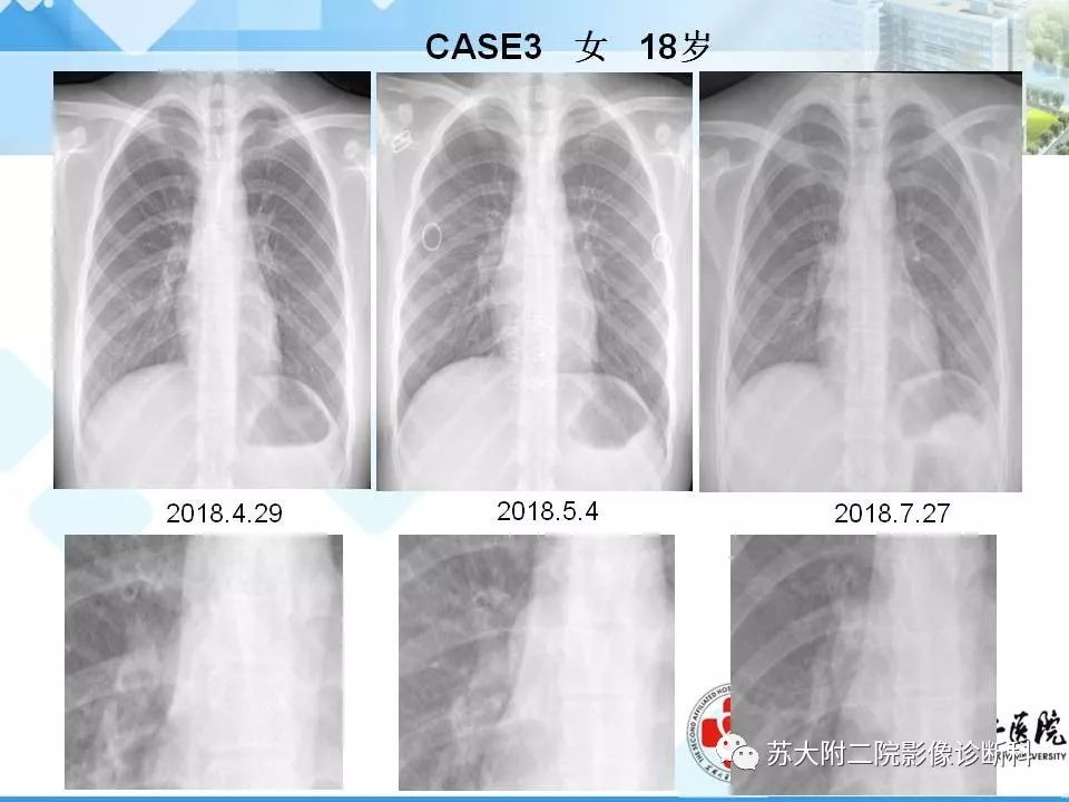 影像PPT - 【PPT】胸部X线平片的漏诊陷阱-6