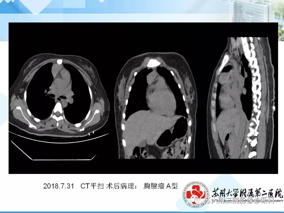 影像PPT - 【PPT】胸部X线平片的漏诊陷阱-7