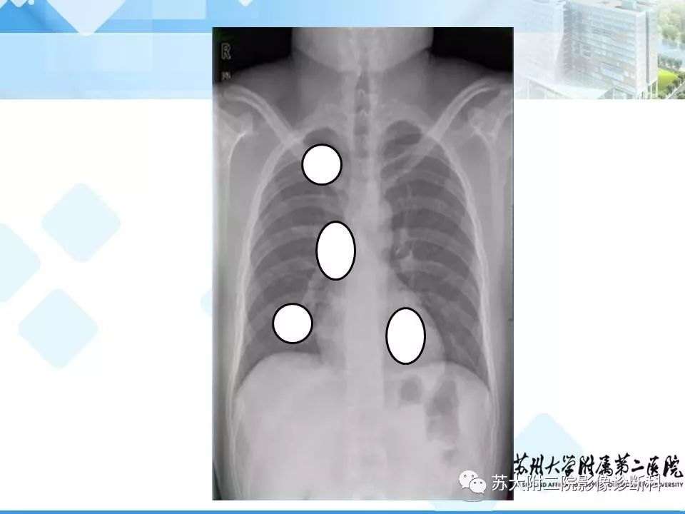 影像PPT - 【PPT】胸部X线平片的漏诊陷阱-11