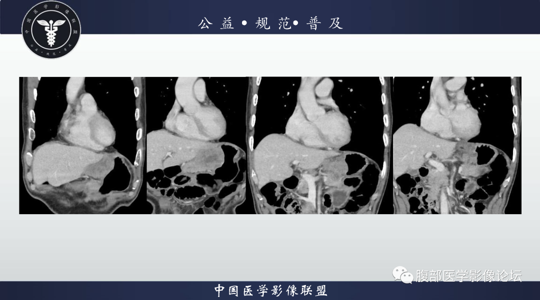 影像PPT - 【病例】胃神经内分泌癌1例CT影像-13