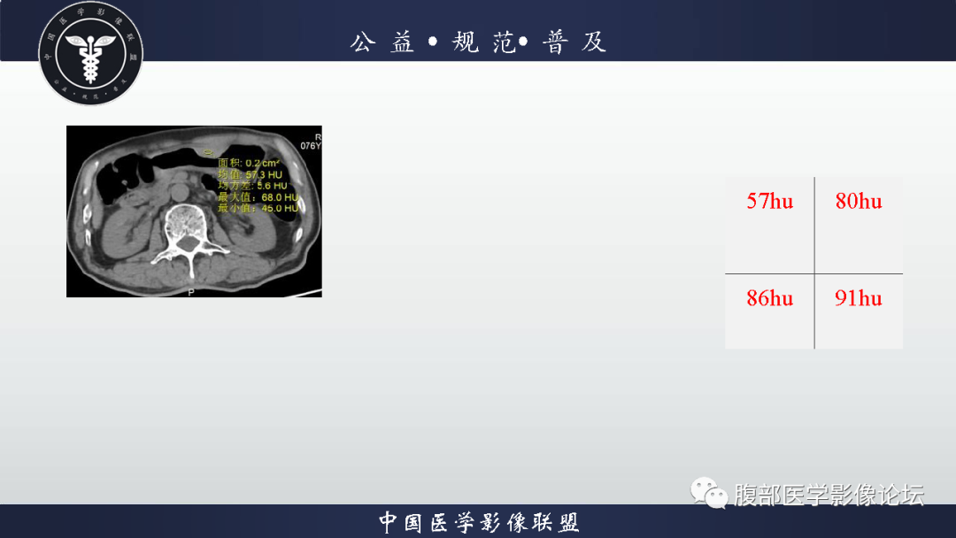 影像PPT - 【病例】胃神经内分泌癌1例CT影像-16