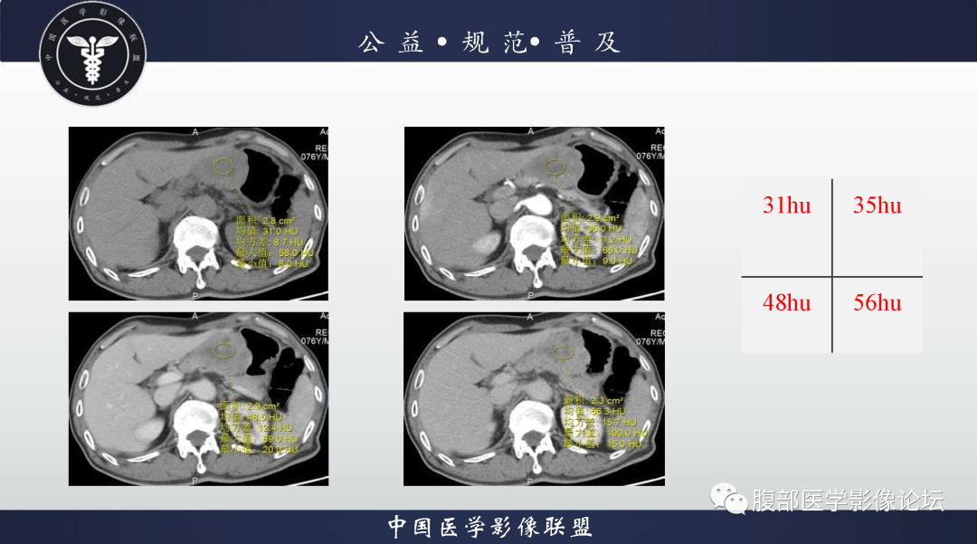 影像PPT - 【病例】胃神经内分泌癌1例CT影像-15