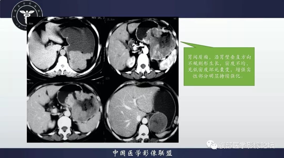 影像PPT - 【病例】胃神经内分泌癌1例CT影像-30
