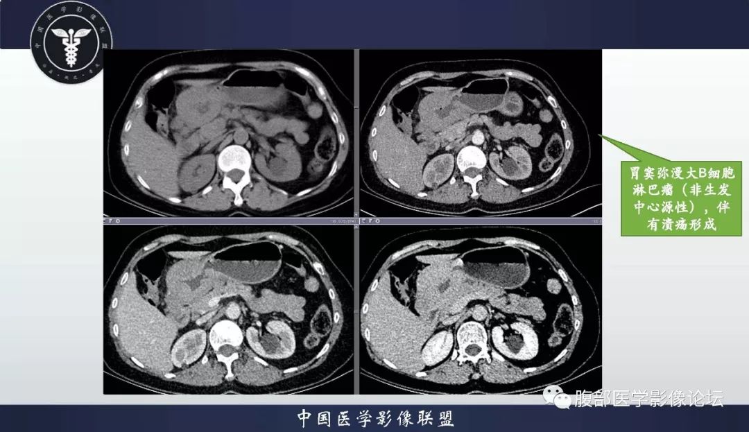影像PPT - 【病例】胃神经内分泌癌1例CT影像-33