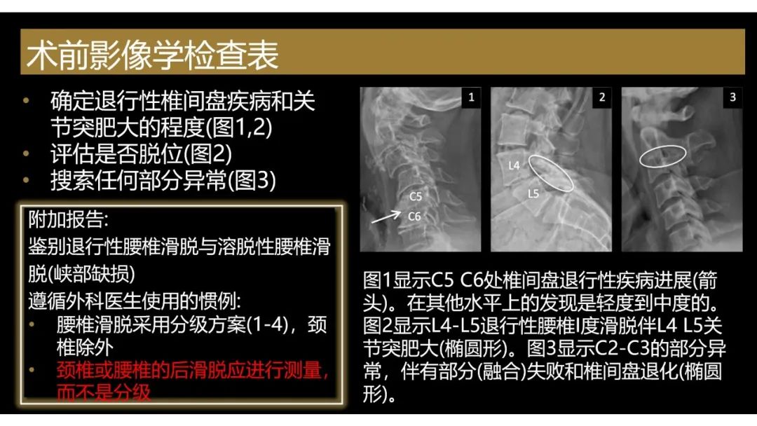 影像PPT - 【PPT】评估围手术期脊柱:除了退行性椎间盘疾病和金属植入物的并发症外-7