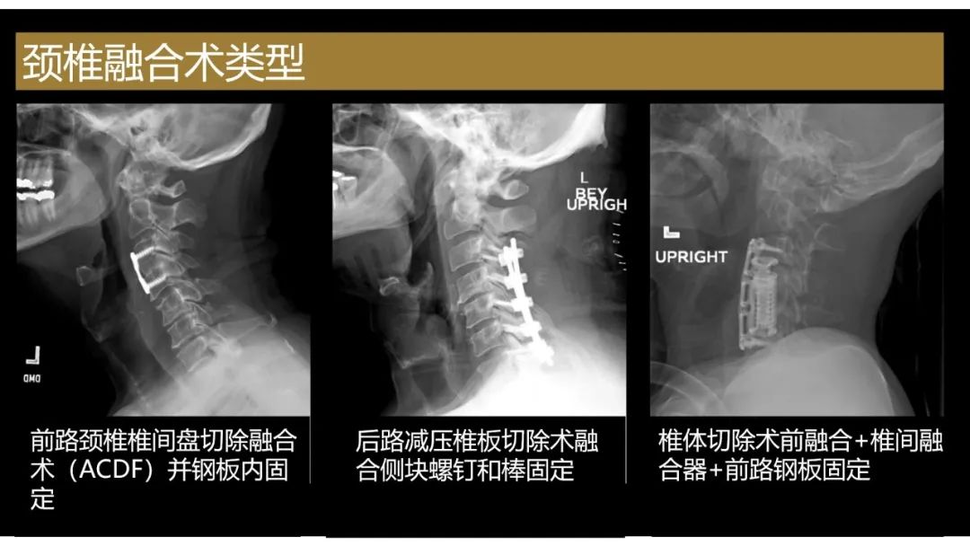 影像PPT - 【PPT】评估围手术期脊柱:除了退行性椎间盘疾病和金属植入物的并发症外-11