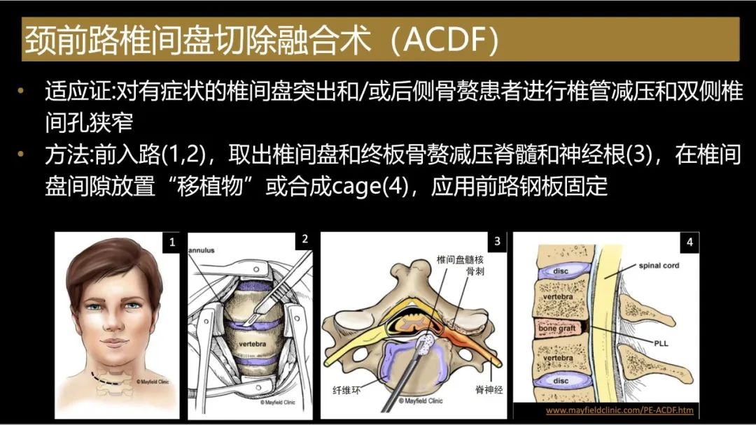影像PPT - 【PPT】评估围手术期脊柱:除了退行性椎间盘疾病和金属植入物的并发症外-13