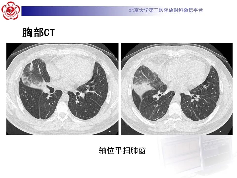 影像PPT - 【PPT】嗜酸性肉芽肿性多血管炎-5