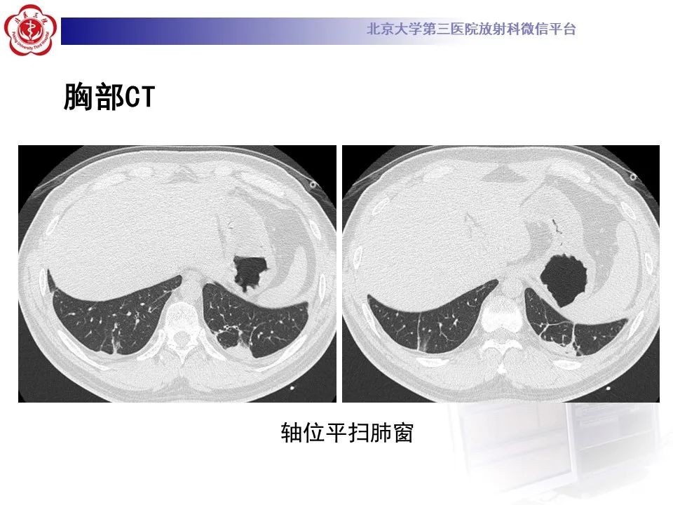 影像PPT - 【PPT】嗜酸性肉芽肿性多血管炎-6