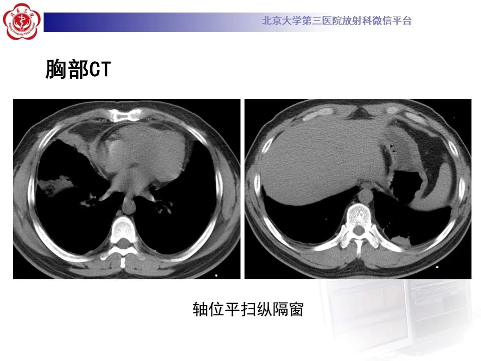 影像PPT - 【PPT】嗜酸性肉芽肿性多血管炎-7