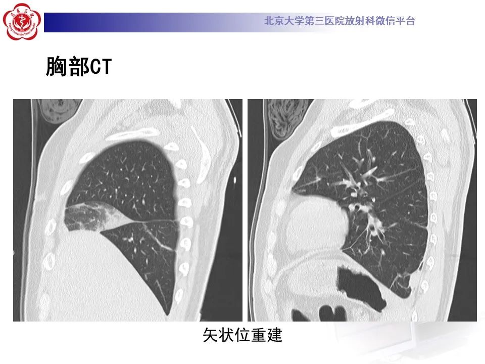 影像PPT - 【PPT】嗜酸性肉芽肿性多血管炎-8