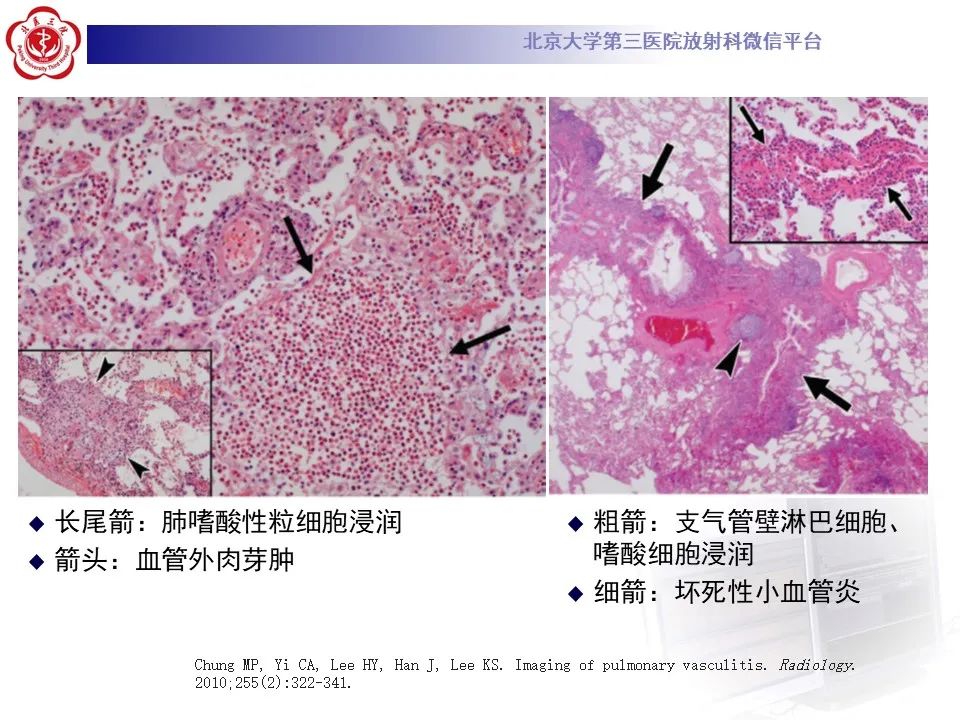 影像PPT - 【PPT】嗜酸性肉芽肿性多血管炎-22