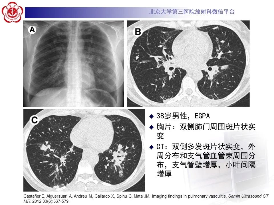 影像PPT - 【PPT】嗜酸性肉芽肿性多血管炎-27
