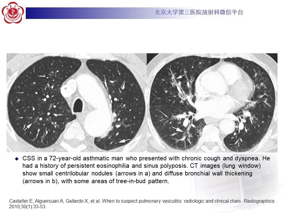 影像PPT - 【PPT】嗜酸性肉芽肿性多血管炎-28