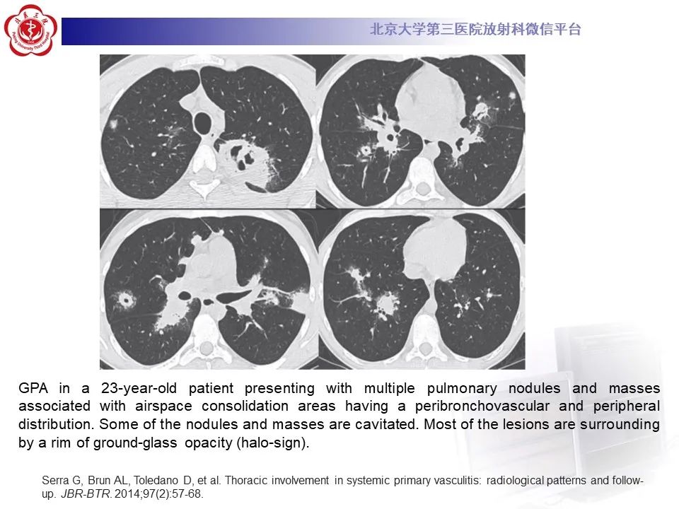 影像PPT - 【PPT】嗜酸性肉芽肿性多血管炎-31
