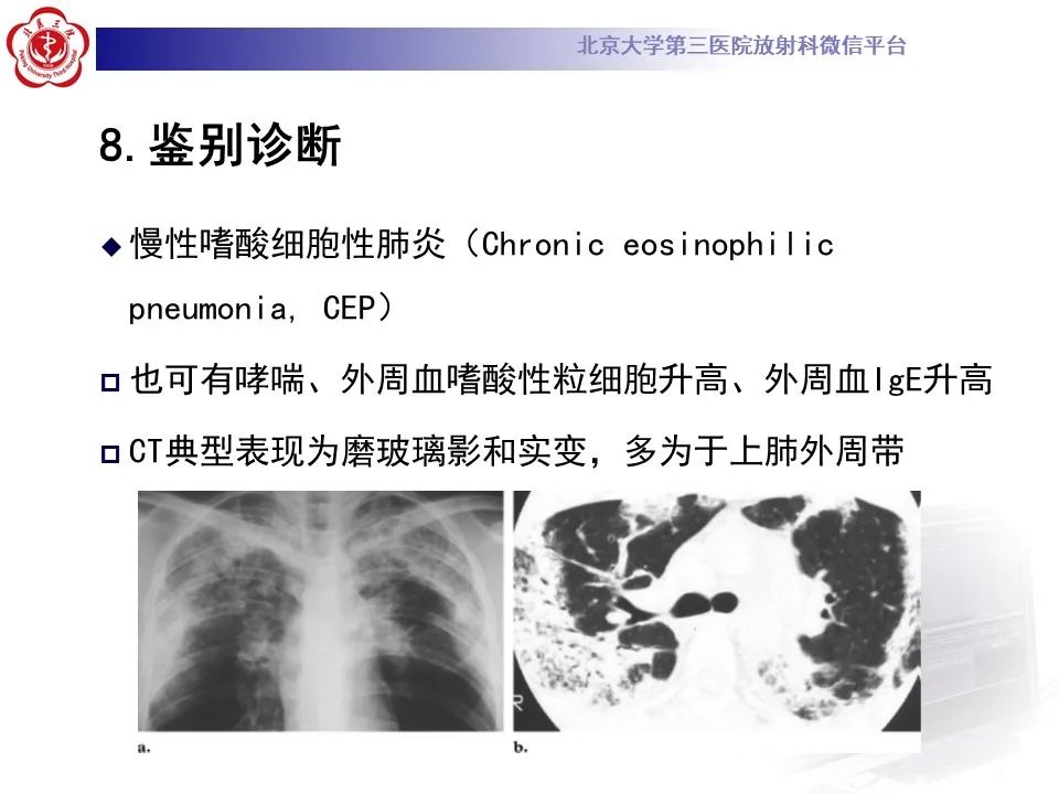 影像PPT - 【PPT】嗜酸性肉芽肿性多血管炎-33