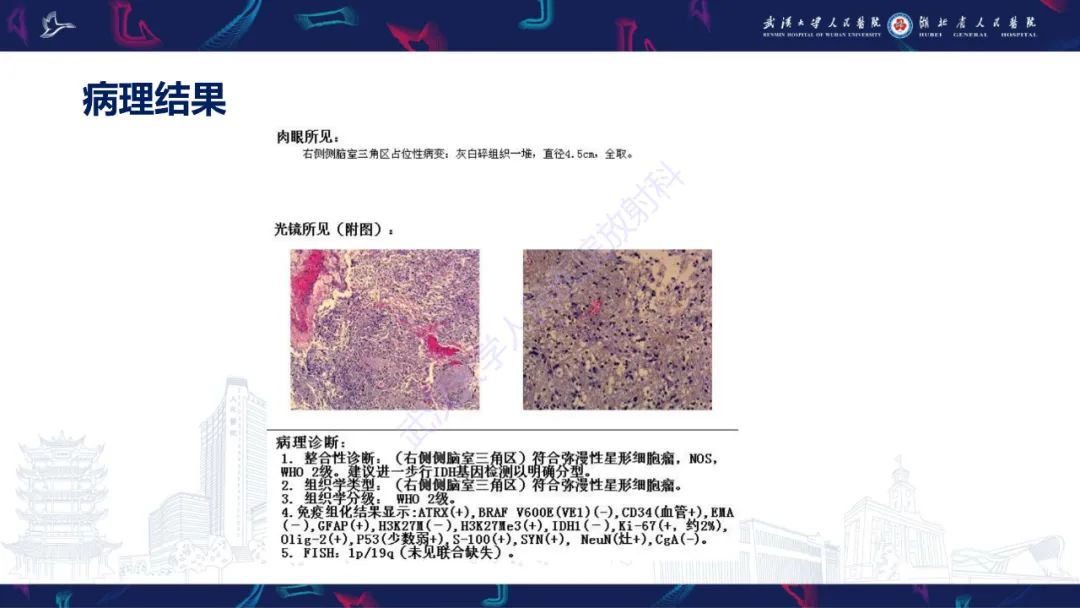 影像PPT - 【PPT】侧脑室肿瘤影像诊断-6