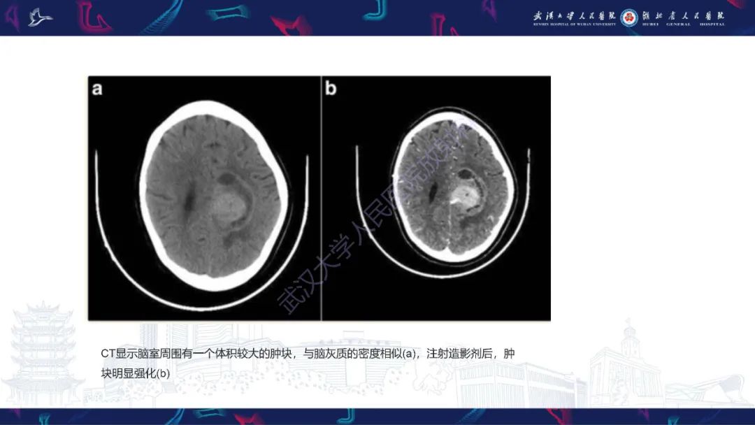 影像PPT - 【PPT】侧脑室肿瘤影像诊断-10