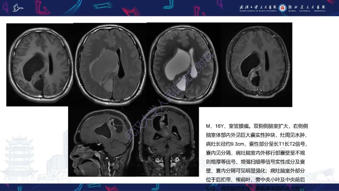 影像PPT - 【PPT】侧脑室肿瘤影像诊断-14