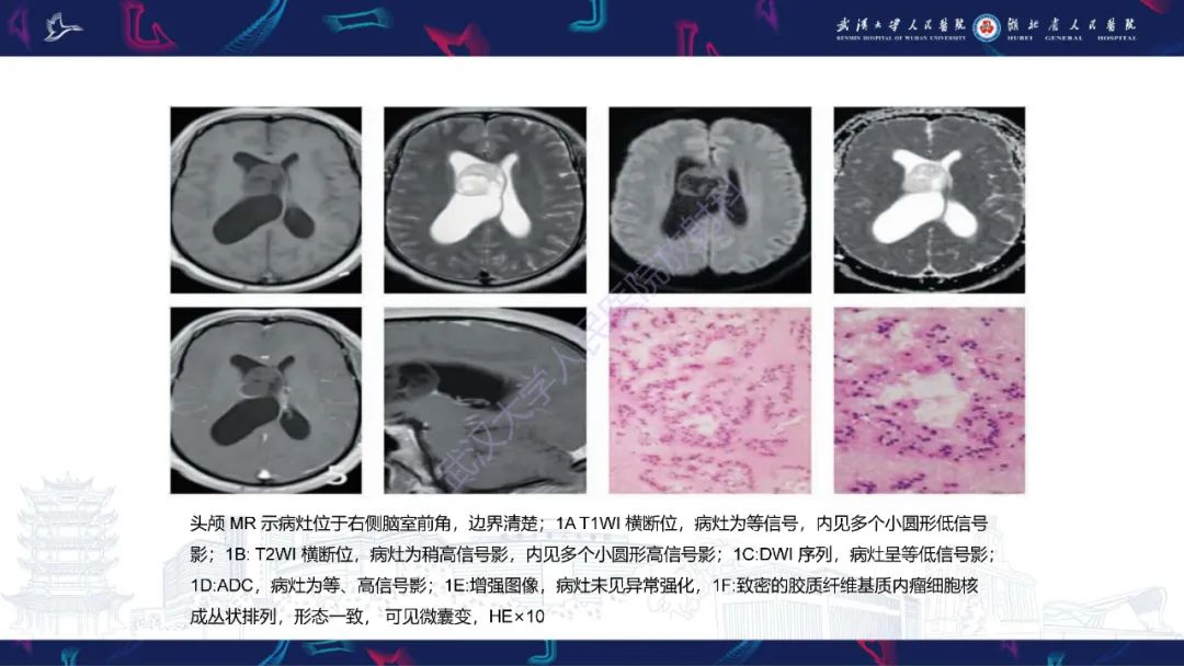 影像PPT - 【PPT】侧脑室肿瘤影像诊断-16