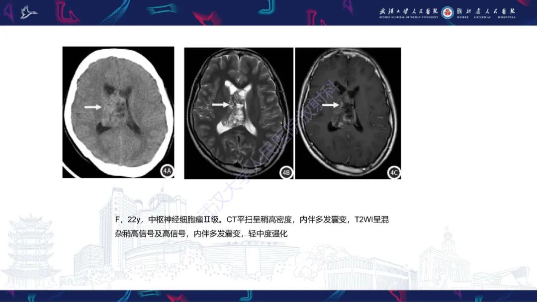影像PPT - 【PPT】侧脑室肿瘤影像诊断-18
