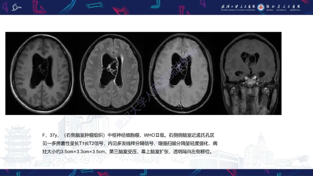 影像PPT - 【PPT】侧脑室肿瘤影像诊断-19