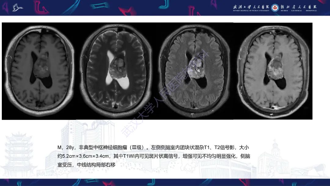 影像PPT - 【PPT】侧脑室肿瘤影像诊断-20
