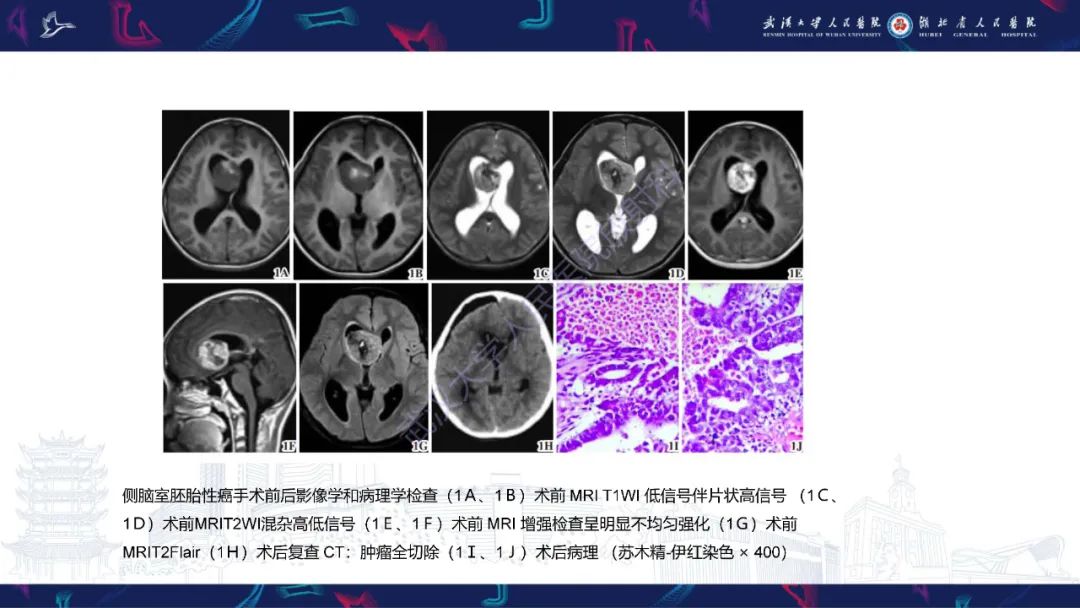 影像PPT - 【PPT】侧脑室肿瘤影像诊断-22