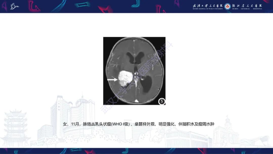 影像PPT - 【PPT】侧脑室肿瘤影像诊断-25