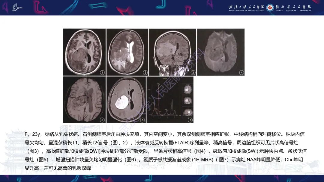 影像PPT - 【PPT】侧脑室肿瘤影像诊断-26
