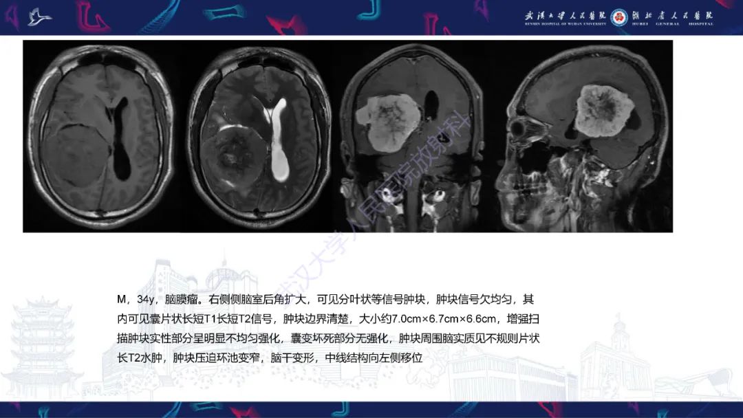 影像PPT - 【PPT】侧脑室肿瘤影像诊断-28